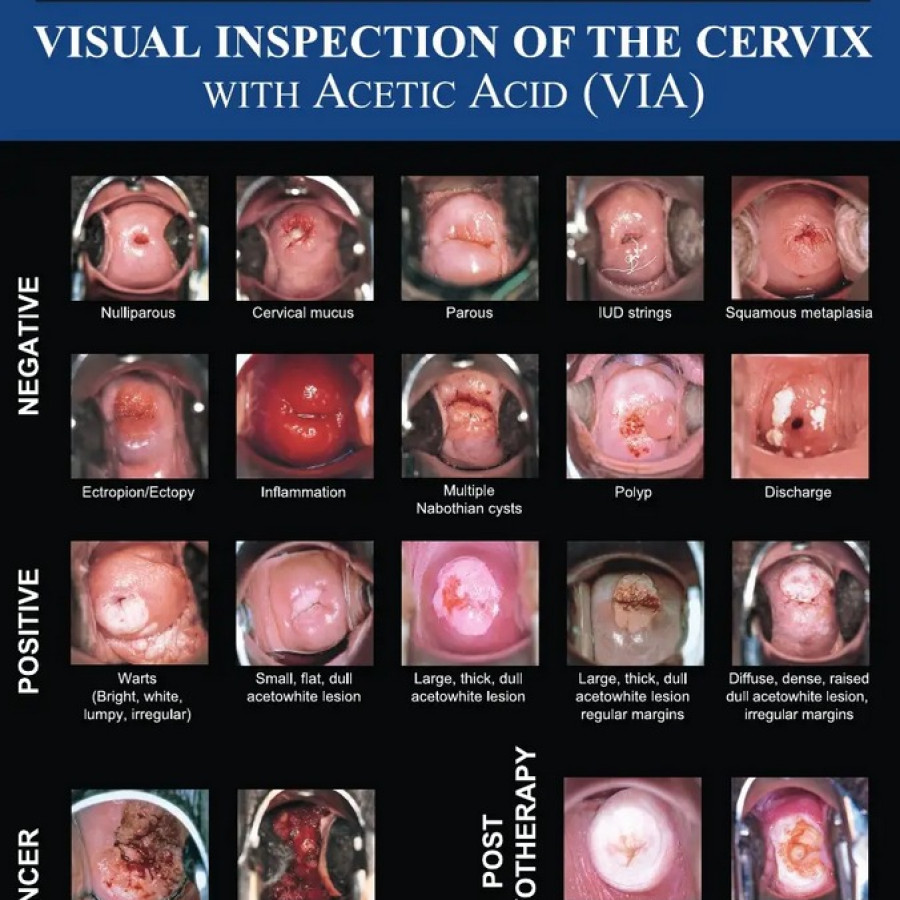 VISUAL INSPECTION OF CERVIX (VIA)